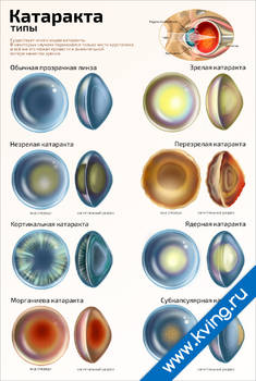 Плакат типы катаракты