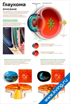 Плакат глаукома