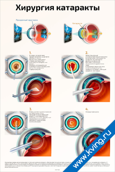 Плакат хирургия катаракты