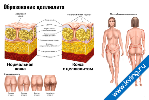 Плакат образование целлюлита