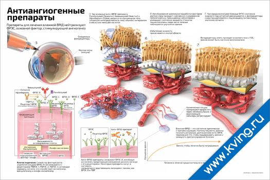 Плакат антиангиогенные препараты для лечения влажной вмд