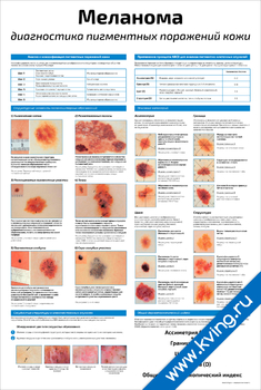 Плакат меланома: диагностика пигментных поражений кожи