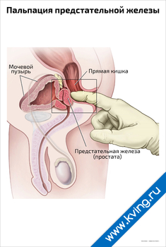 Плакат пальпация предстательной железы
