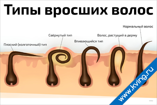 Плакат типы вросших волос