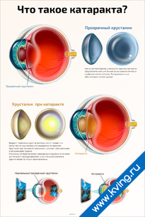 Плакат что такое катаракта?