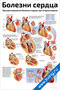 плакат с подробными иллюстрациями и схемами по теме болезни сердца, атеросклероз, инфаркт миокарда, гипертония и сердечная недостаточность