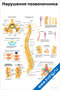 Плакат с подробными анатомическими схемами нарушений позвоночника, строения позвонков и межпозвоночных дисков для медицинского изучения