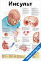 Плакат инсульт с иллюстрациями головного мозга, схемами кровоснабжения и описанием причин, видов и последствий инсульта для наглядного изучения