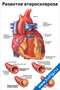 плакат развитие атеросклероза с подробными схемами сосудов, этапами формирования холестериновых бляшек и изменениями артерий
